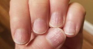 تعبیر خواب کنده شدن ناخن دست و پا + افتادن از حضرت یوسف و ابن سیرین