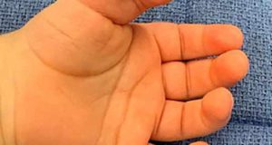 تعبیر خواب انگشت اضافه داشتن + درآوردن از دست و پا برای زن و دختر مجرد