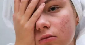 تعبیر خواب جوش صورت + از نظر امام صادق و حضرت یوسف و ترکاندن جوش ها