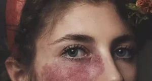 تعبیر خواب سوختن صورت امام صادق + صورت سوخته زن و دختر مجرد و دیگران
